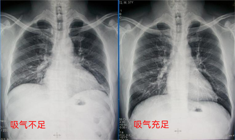 一分钟读懂,胸部DR检查【海河科普】-天津市海河医院-北方网企业建站
